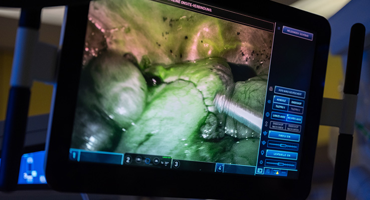 ICG-Fluoreszenztechnologie in der robotischen Chirurgie 3D-Operationsansicht mit ICG-Fluoreszenz während einer robotisch assistierten Operation.